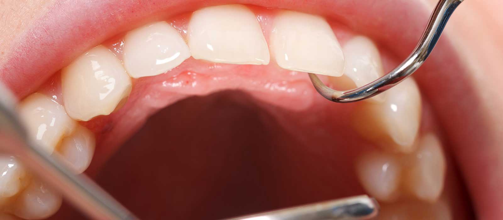 歯歯周病治療